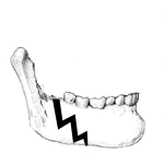 Avec fracture pathologique