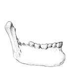 Sans fracture pathologique